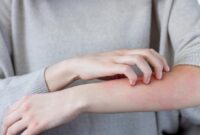 1766012667704-ilustrasi-ruam-kulit_169